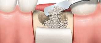 Восстановление костной ткани челюсти: ключевые аспекты и методики