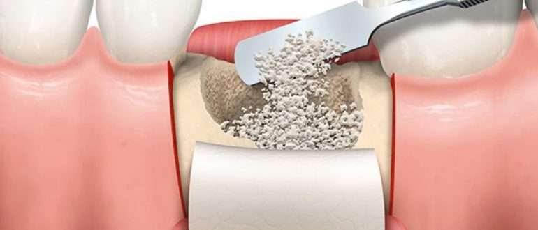 Восстановление костной ткани челюсти: ключевые аспекты и методики