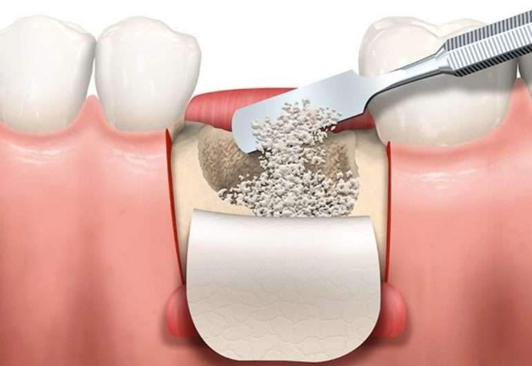 Восстановление костной ткани челюсти: ключевые аспекты и методики