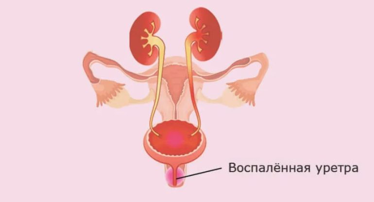 Воспаление уретры у женщин: причины, симптомы и лечение недуга